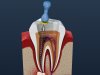 5 Common Types of Dental Emergencies