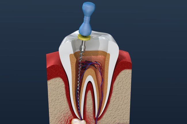 5 Common Types of Dental Emergencies