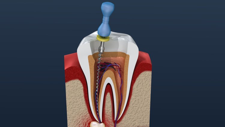 5 Common Types of Dental Emergencies